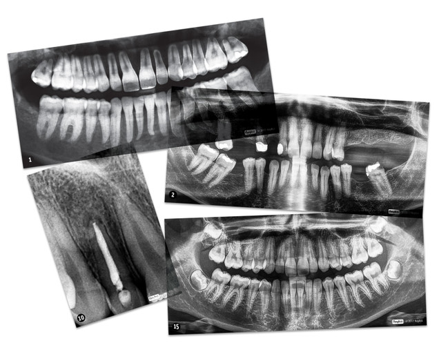 Dental X Ray Pictures